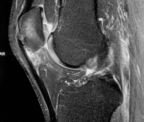 Jumpers Knee MRI